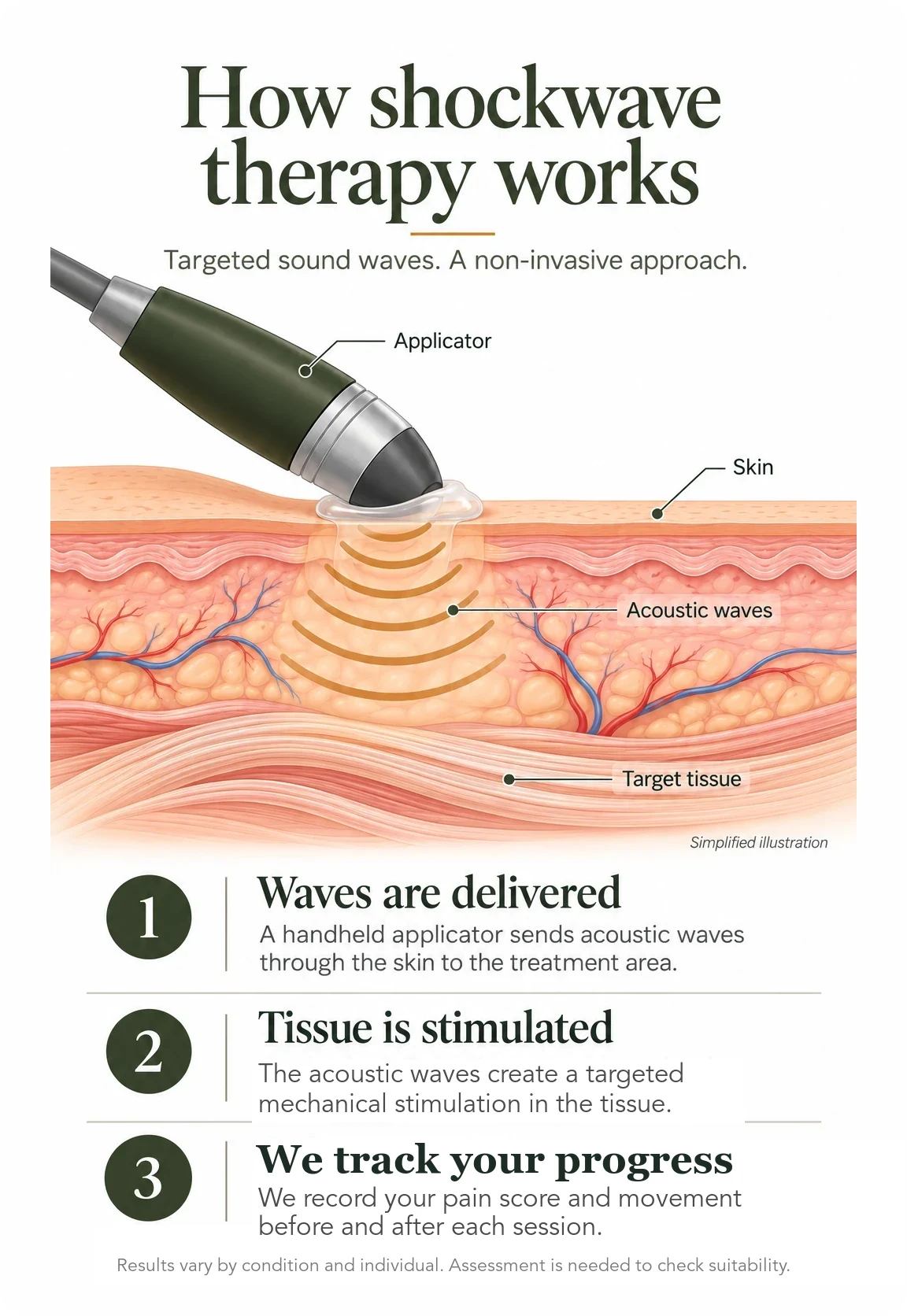 Infographic: how shockwave therapy works. A handheld applicator on the skin sends acoustic waves through to the target tissue underneath. Step 1, waves are delivered. Step 2, tissue is stimulated. Step 3, we track your progress by recording your pain score and movement before and after each session. Results vary by condition and individual, and an assessment is needed to check suitability.